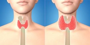 3D Abbildung von normaler Schilddrüse und vergrößerter Schilddrüse 3D Abbildung von normaler Schilddrüse und vergrößerter Schilddrüse